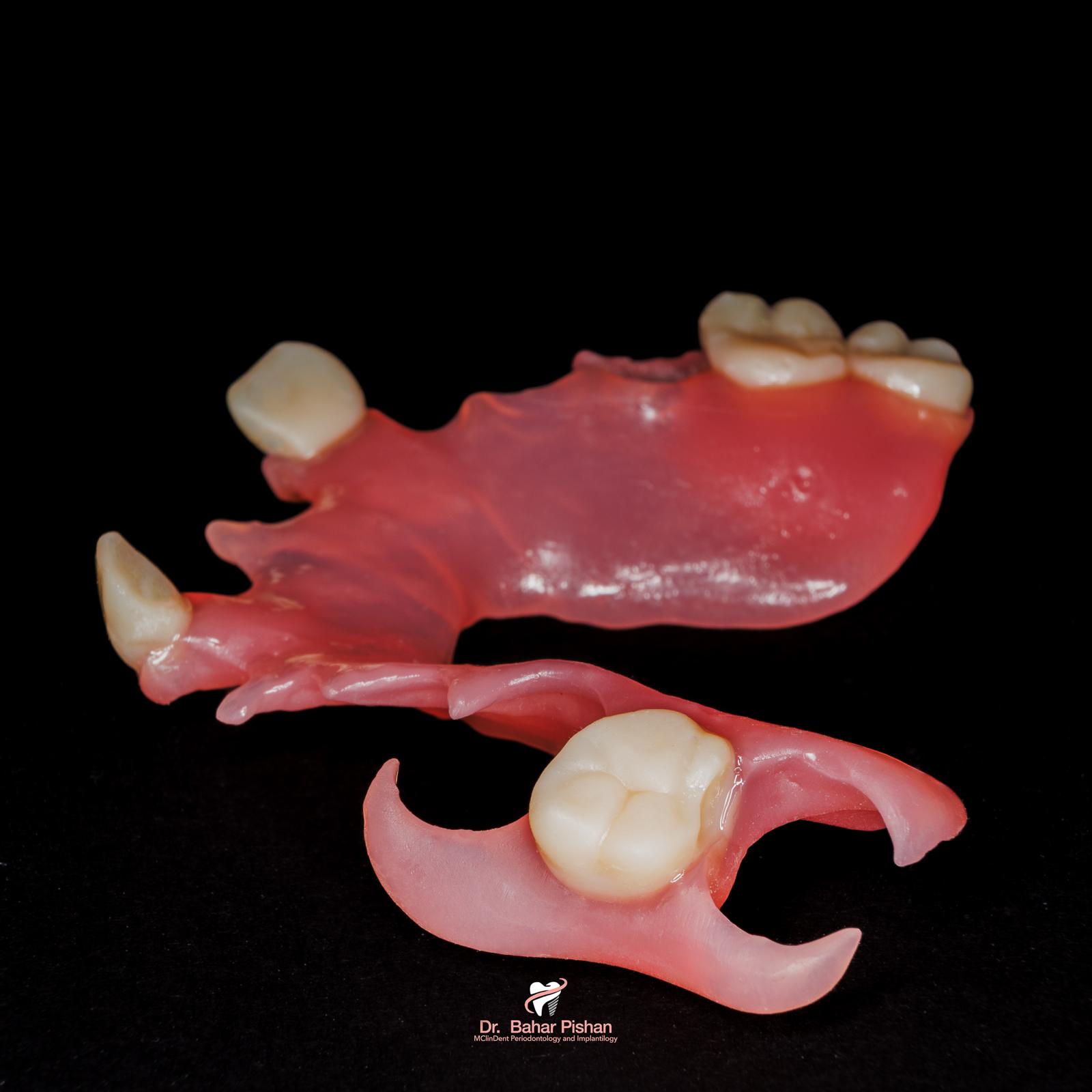 Passgenauer Zahnersatz aus dem 3D-Drucker