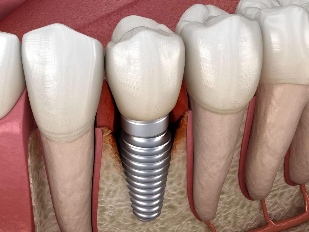 Periimplantitis – Entzündung rund um das Zahnimplantat