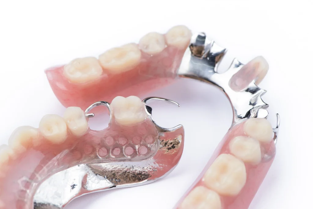 Detailansicht einer herausnehmbaren Teilprothese mit Metallklammern auf einem Gebissmodell