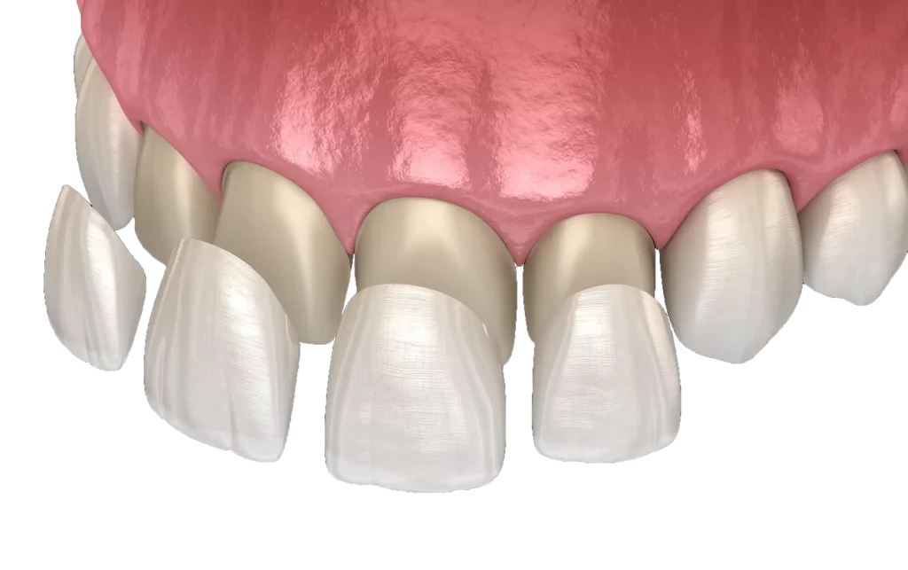 Veneers
